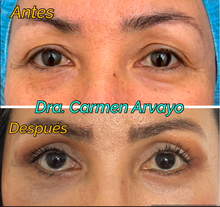 Resultado antes y después de endoláser en párpados