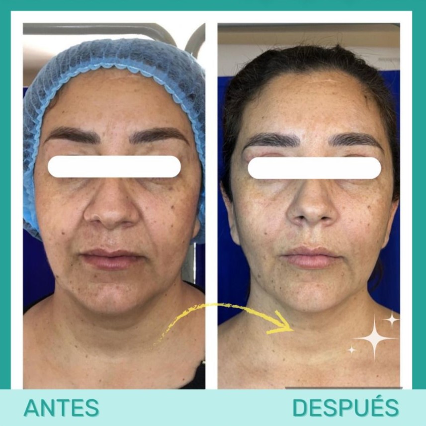Resultado de rejuvenecimiento facial