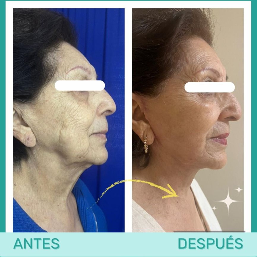 Resultado de armonización facial