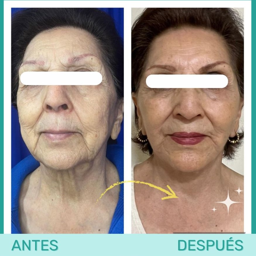 Resultado de tratamiento facial